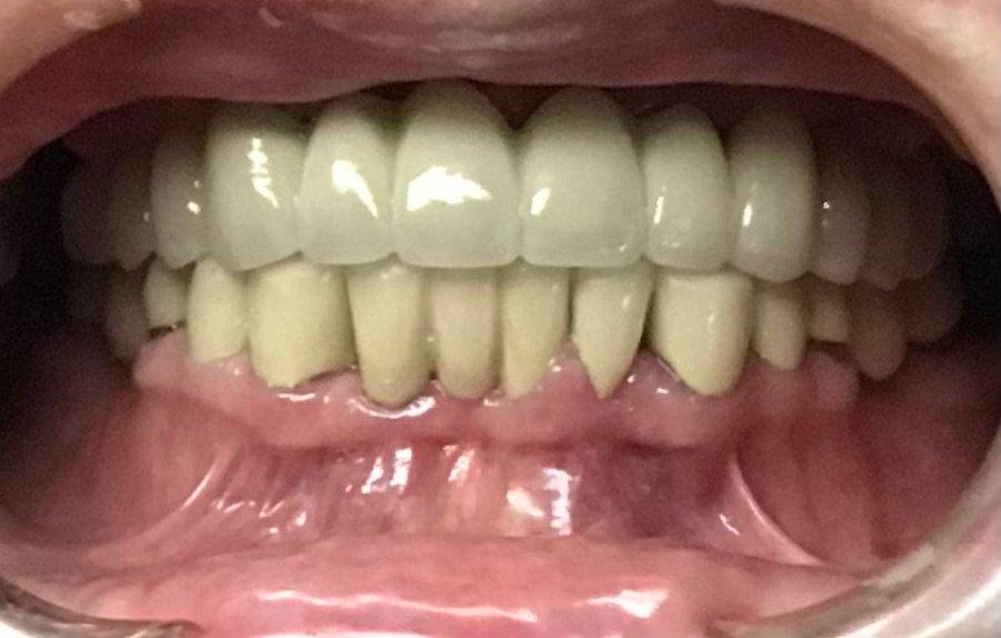 Full Mouth Reconstruction: AFTER