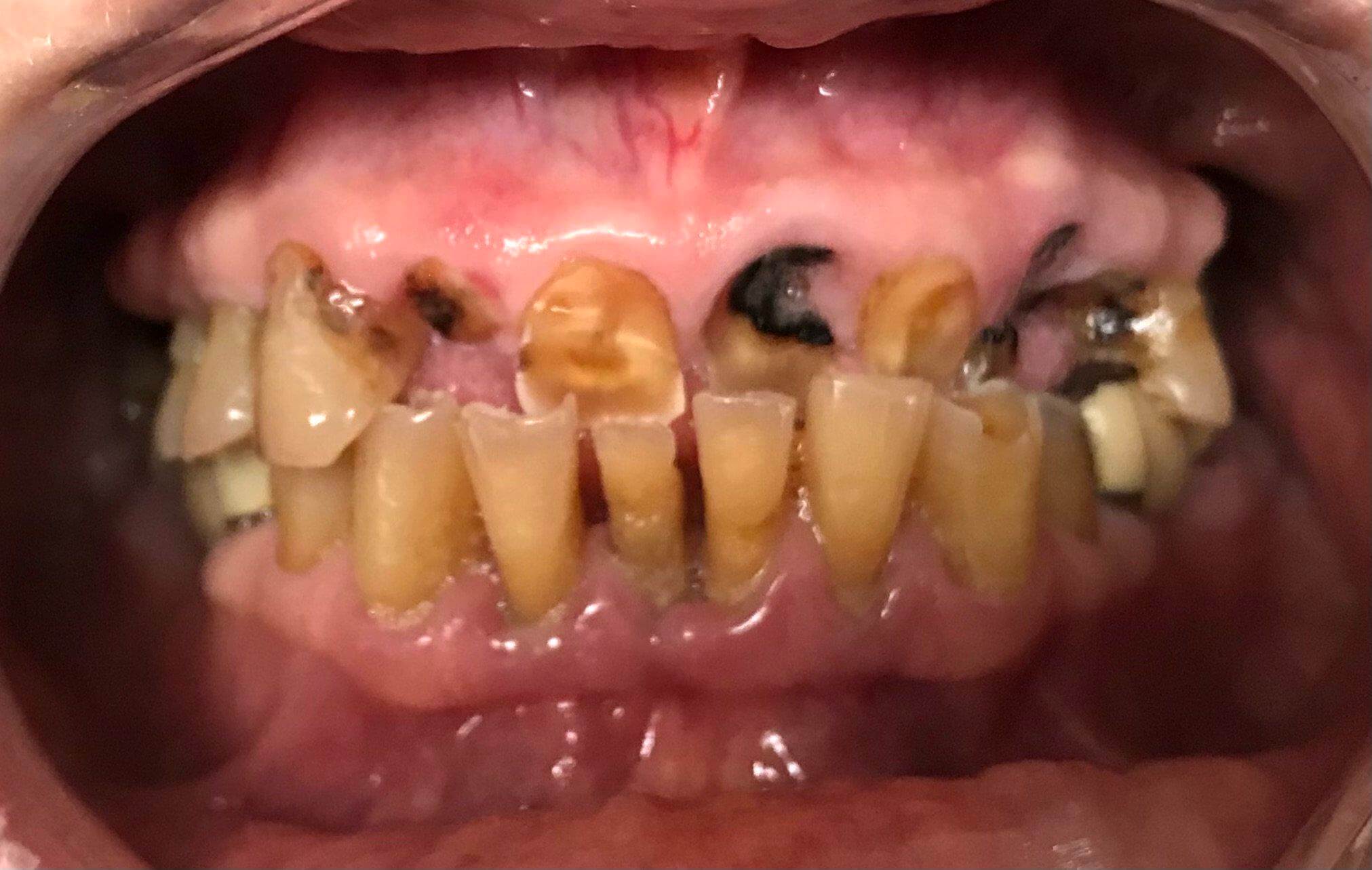 Full Mouth Reconstruction: BEFORE