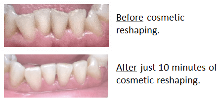 What Is Cosmetic Reshaping?