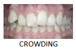 Crowding