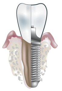 What Is A Dental Implant?