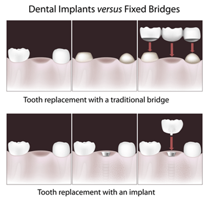 A Single Dental Implant Or A Fixed Bridge?