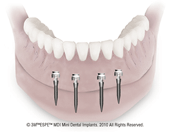 What Are Implant Dentures?