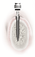 What Are Implant Dentures?