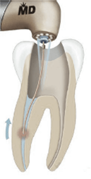 How Are Lasers Used In Root Canal Treatment?