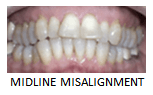 Midline Misalignment