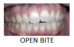 Open Bite