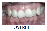 Overbite