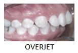 Overjet