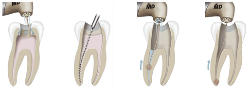 What Is Involved In A Root Canal Procedure?