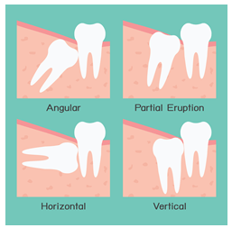 Do Wisdom Teeth Have To Come Out?